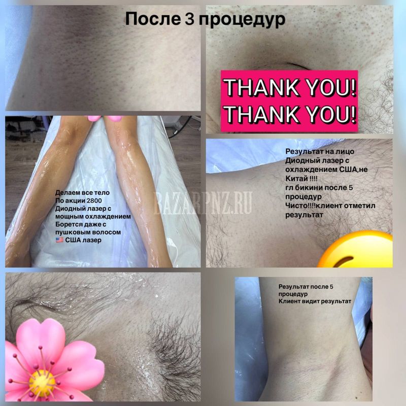 Лазерная эпиляция, акция